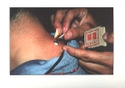 Katharina Sabernig - Moxabehandlung in Tibet
