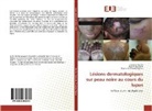 Sophi Coniquet, Sophie Coniquet, Josapha Iba Ba, Josaphat Iba Ba, St Ntsame Ngoua, Stéphanie Ntsame Ngoua - Lésions dermatologiques sur peau noire au cours du lupus