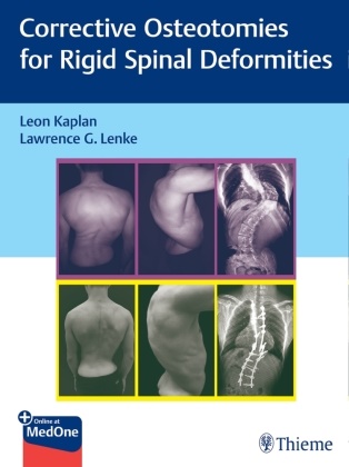G Lenke, Leon Kaplan, Lawrence G. Lenke - Corrective Osteotomies for Rigid Spinal Deformities - Besteht aus: 1 Buch, 1 E-Book