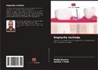 Geetha K Bhat, Mohit Sharma - Implants inclinés