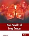 Jute Cassie - Non-Small Cell Lung Cancer