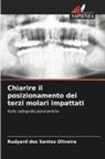 Rudyard Dos Santos Oliveira - Chiarire il posizionamento dei terzi molari impattati