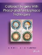 Stephen Brint, Lucio Buratto, Lucio Brint Buratto, Buratto Lucio, Rosalia Sorce, Sorce Rosalia - Cataract Surgery With Phaco and Femtophaco Techniques