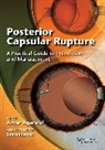 Amar Agarwal, Agarwal Amar - Posterior Capsular Rupture
