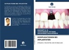 Rakshit B M, Rakshit B. M., Shivshankar Mithare, Moh Nashiroddin, Mohammed Nashiroddin - KOMPLIKATIONEN BEI IMPLANTATEN