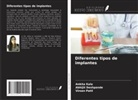 Abhijit Deshpande, Ankita Kale, Virsen Patil - Diferentes tipos de implantes